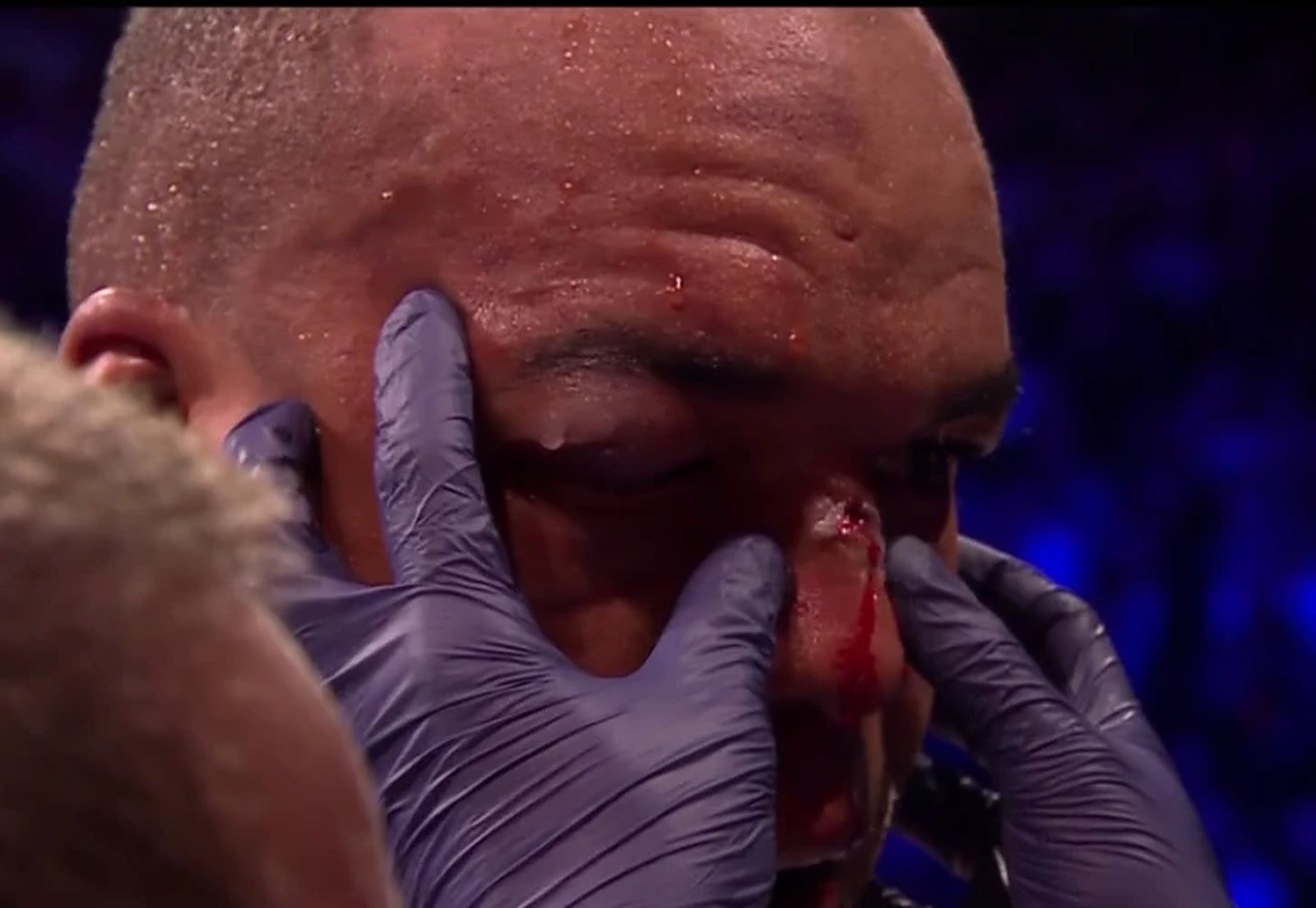 Cutman working on Wardley's nose between rounds